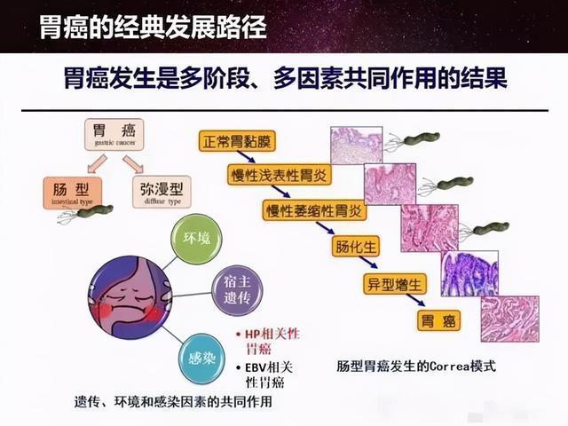 研究：定期换筷子可降低胃癌发病率